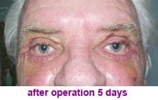 plastic-surgery-blepharoplasty